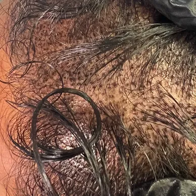 smp, scalp micropigmentation. scalp tattooing between the hair follicles to give a fuller look.